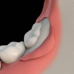 Wisdom Teeth
