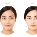 Botox injections in the masseter muscles