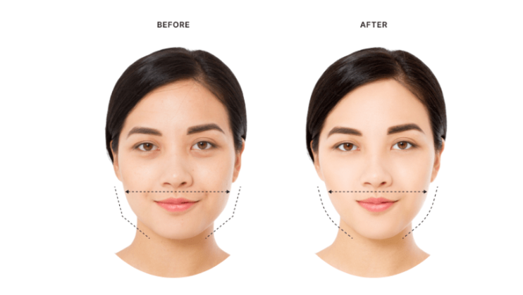 Botox injections in the masseter muscles